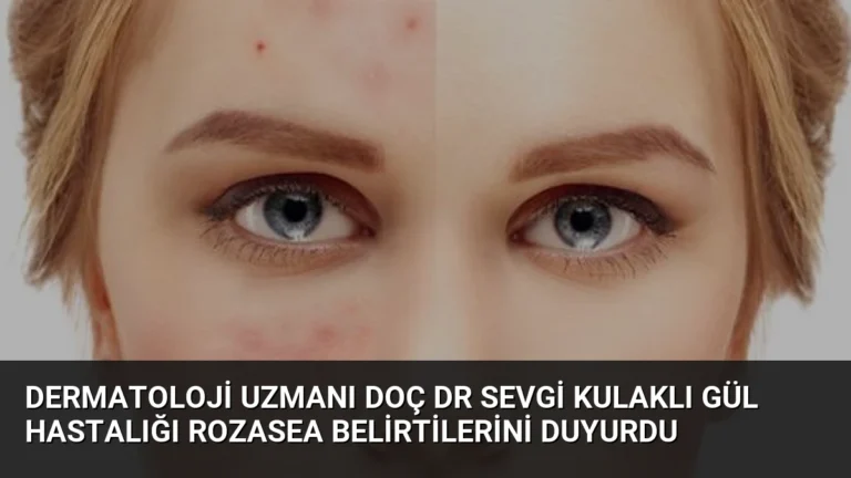 Dermatoloji Uzmanı Doç Dr Sevgi Kulaklı Gül Hastalığı Rozasea Belirtilerini Duyurdu