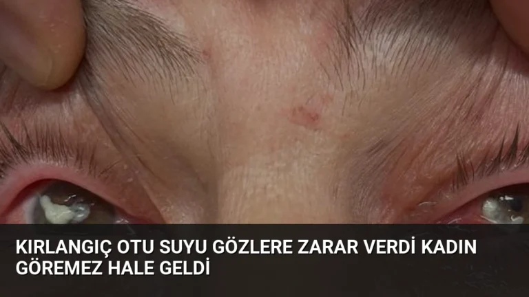 Kırlangıç Otu Suyu Gözlere Zarar Verdi Kadın Göremez Hale Geldi